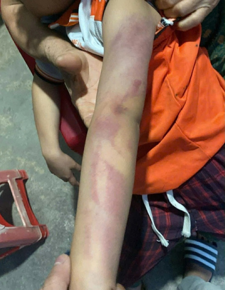 Vết thương ở tay bé gái lớp 2. Ảnh: NVCC