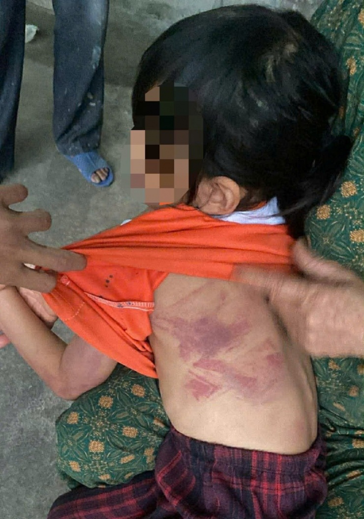 Các vết bầm tím xuất hiện trên người bé gái. Ảnh: NVCC