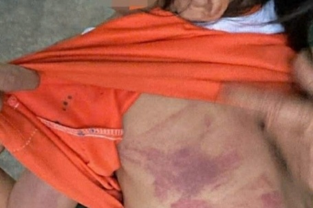 Bé gái lớp 2 bị bạn dùng thước đánh bầm tím người