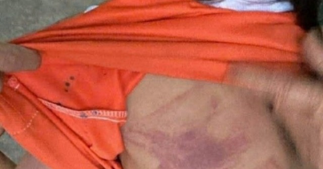 Bé gái lớp 2 bị bạn dùng thước đánh bầm tím người