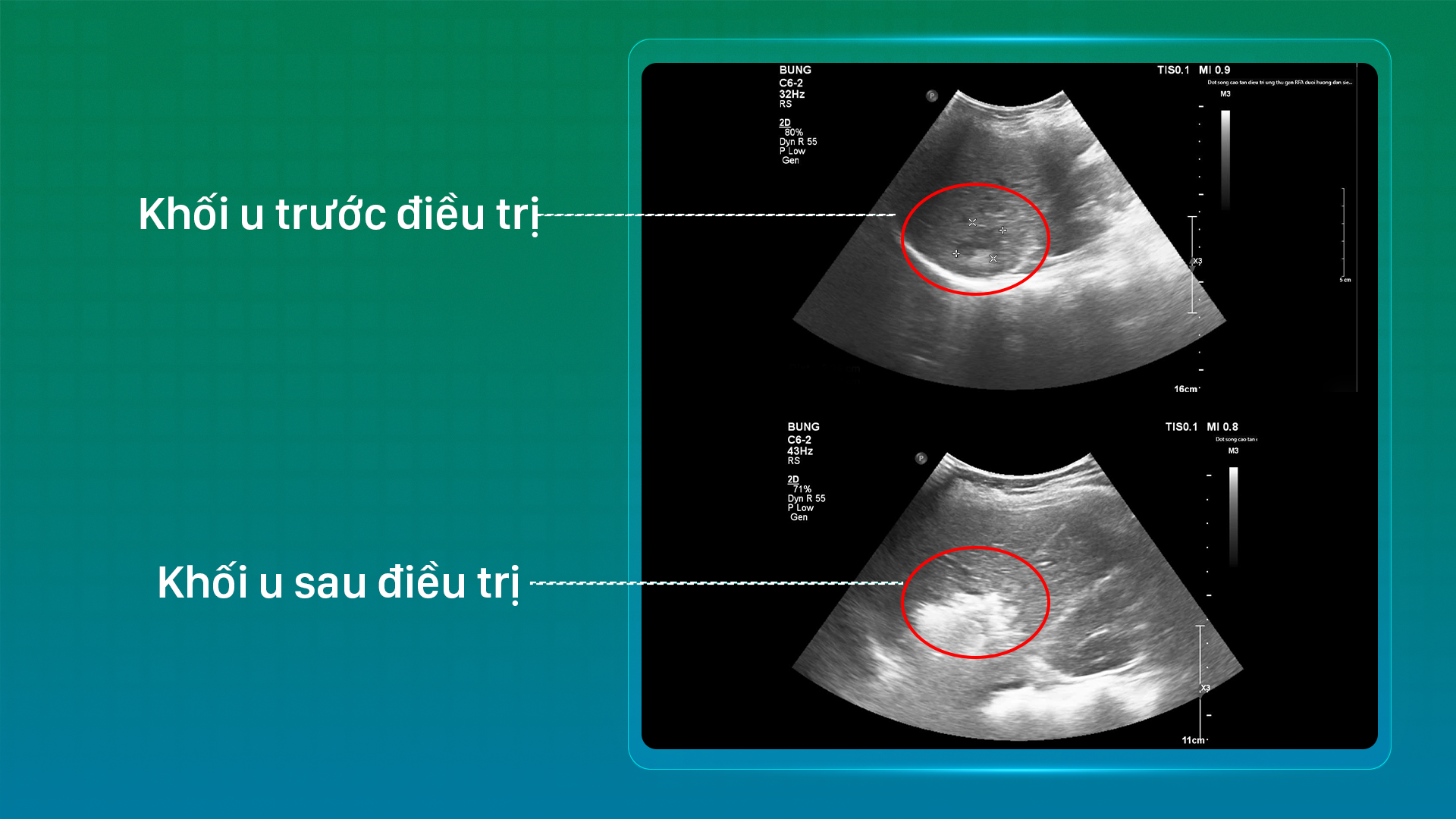 Khối u trước và sau điều trị của bệnh nhân
