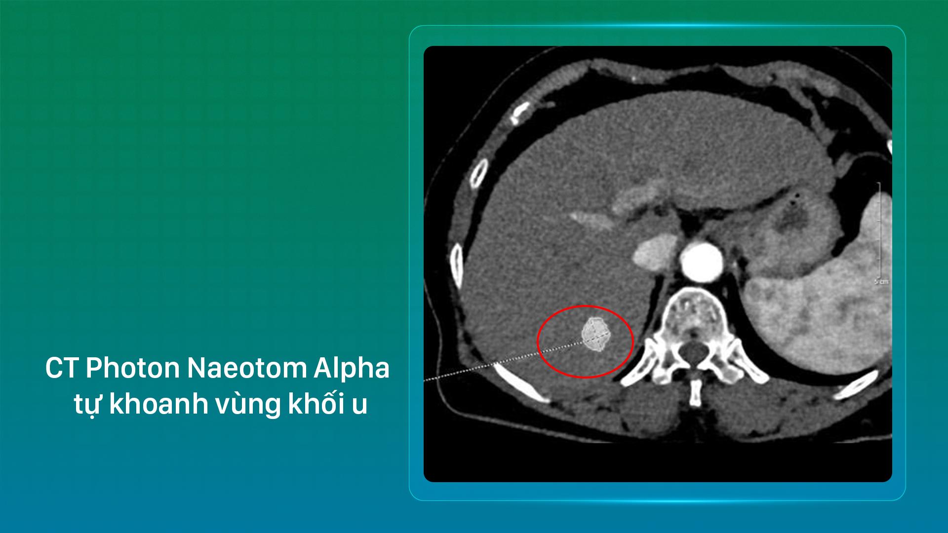 Hình ảnh khối u được máy chụp CT Naeotom Alpha khoanh vùng chi tiết