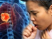 2 dấu hiệu khi ho cảnh báo ung thư phổi dễ bị bỏ qua