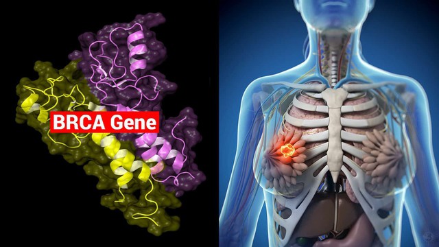 Nguyên nhân phổ biến nhất gây ung thư vú di truyền là đột biến gene BRCA1 hoặc BRCA2.