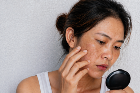 Vì sao thoa kem chống nắng hàng ngày mà da vẫn đen?