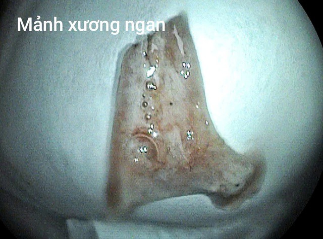 Hình ảnh mảnh xương ngan trong thực quản bệnh nhân.
