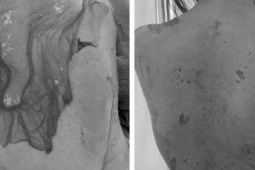 Người phụ nữ 35 tuổi bị tróc da toàn thân thừa nhận 1 sai lầm nhiều người Việt mắc phải