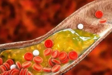 Xơ vữa động mạch diễn ra thế nào, làm sao để đảo ngược?