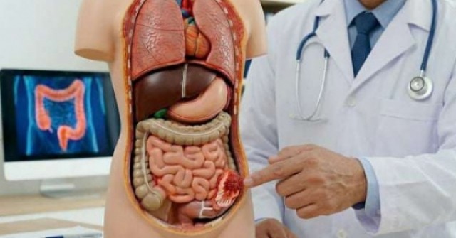 Tỷ lệ tử vong do ung thư đại trực tràng đang gia tăng ở người trẻ