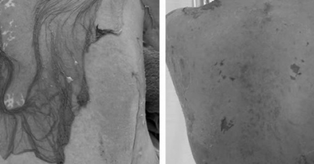 Người phụ nữ 35 tuổi bị tróc da toàn thân thừa nhận 1 sai lầm nhiều người Việt mắc phải