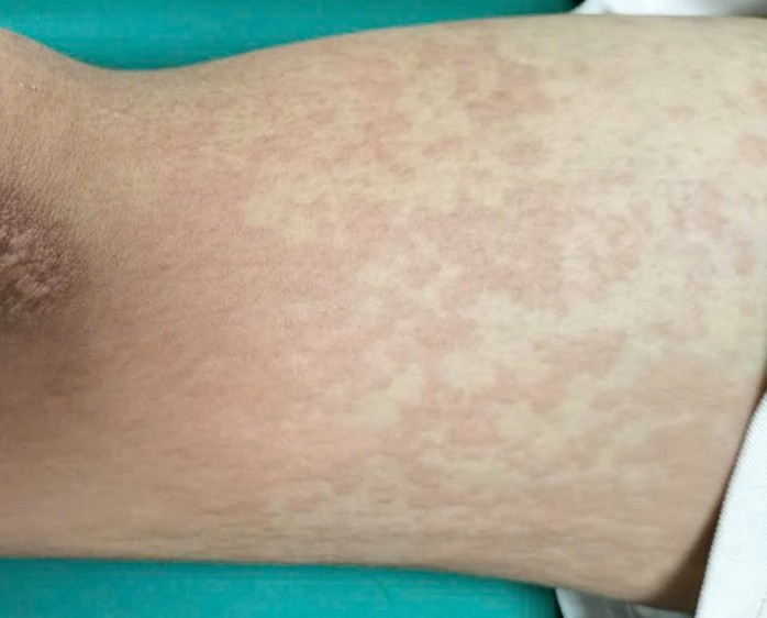 Nam sinh nhập viện cấp cứu trong tình trạng nổi ban đỏ, ngứa toàn thân. Ảnh: Bác sĩ cung cấp