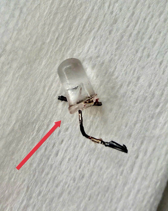 Dị vật là bóng đèn LED được bác sĩ gắp ra khỏi phế quản bệnh nhi