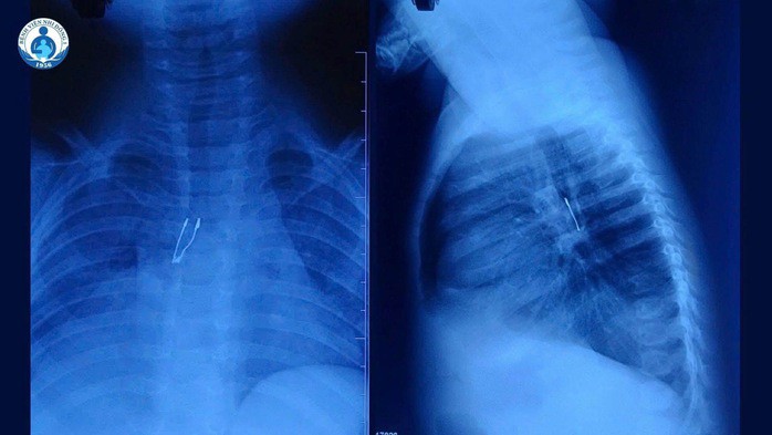Hình ảnh X-quang cho thấy dị vật nằm ở phế quản gốc phải bệnh nhi