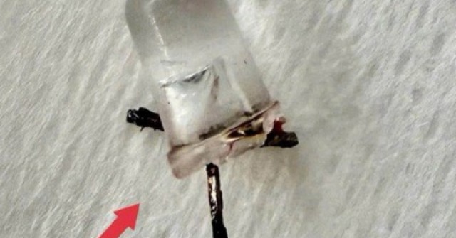 Bác sĩ thót tim gắp đèn LED nằm trong phế quản bé 9 tháng tuổi