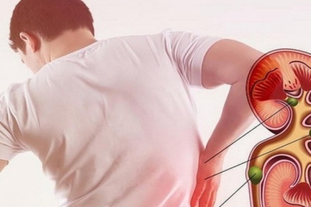 Người đàn ông 35 tuổi mắc suy thận mạn tính từ những món ăn quen thuộc tại hàng quán