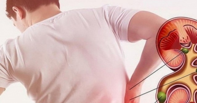 Người đàn ông 35 tuổi mắc suy thận mạn tính từ những món ăn quen thuộc tại hàng quán