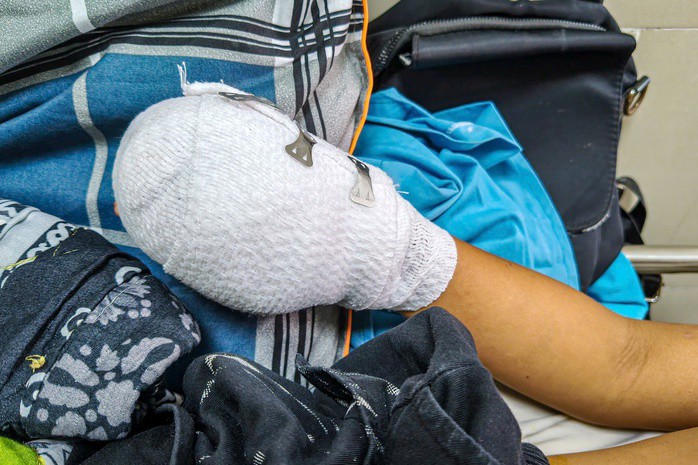 Bàn tay cháu bé bị thương nặng