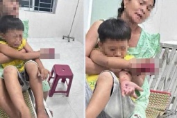 Cháu bé bị dập bàn tay nghi do điện thoại nổ lúc sạc pin