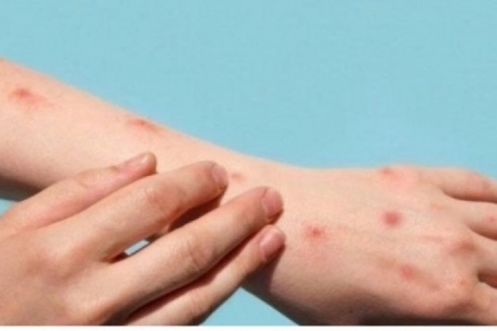 Thủy đậu tăng nhanh khi giao mùa: Làm gì để phòng bệnh hiệu quả?