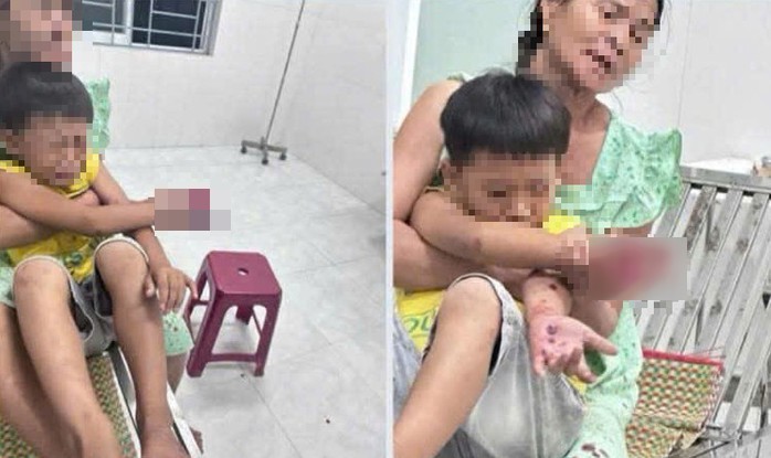 Cháu bé bị dập bàn tay nghi do điện thoại nổ lúc sạc pin - 1