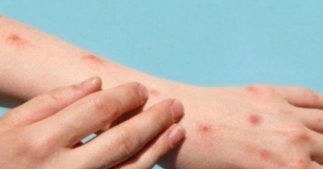 Thủy đậu tăng nhanh khi giao mùa: Làm gì để phòng bệnh hiệu quả?