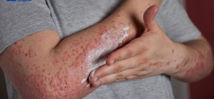 Dùng thuốc không rõ nguồn gốc mua trôi nổi dễ bị nấm da.