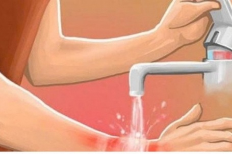 Bị bỏng nước sôi phải làm gì? Hướng dẫn xử trí và phòng tránh