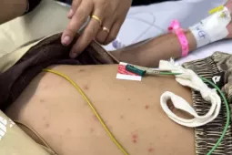 Bé trai mắc não mô cầu thoát chết nhờ phát hiện nốt ‘tử ban’ trên da