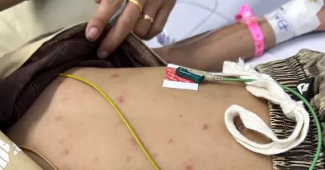 Bé trai mắc não mô cầu thoát chết nhờ phát hiện nốt ‘tử ban’ trên da