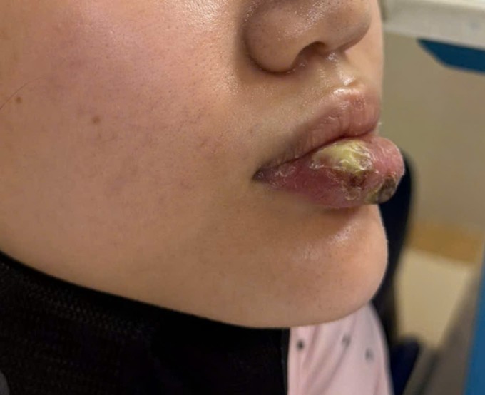 Hình ảnh môi bị nhiễm trùng sau khi sau tiêm "giải filler" tại cơ sở không phép. Ảnh: Bệnh viện Bạch Mai