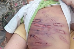 Bé 2 tuổi bị bạo hành đã qua nguy kịch, sức khỏe dần ổn định