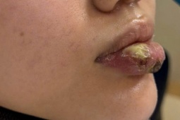Hoại tử môi sau khi tiêm 'giải filler' ở spa không phép