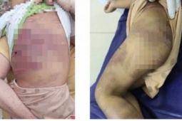 Diễn biến mới nhất vụ bé trai 2 tuổi bị bạo hành ở TPHCM