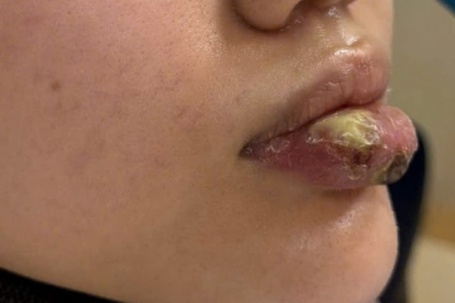 Hoại tử môi sau khi tiêm 'giải filler' ở spa không phép