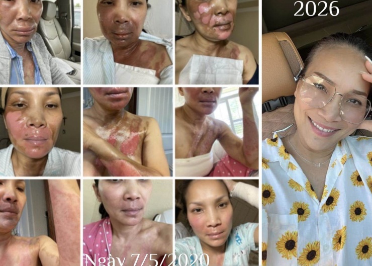 Ca sĩ Hồng Ngọc đăng tải những hình ảnh sau vụ bỏng 6 năm trước trên trang cá nhân. (Ảnh: FBNV)