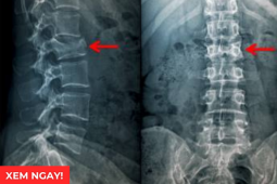 Tin tức sức khỏe - 3 tư thế ngủ tốt nhất giúp giảm đau rõ rệt cho người bị thoái hóa cột sống