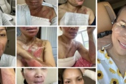 Ca sĩ đình đám của showbiz Việt một thời khoe nhan sắc rạng rỡ sau 6 năm bị bỏng nặng vì nồi xông hơi phát nổ