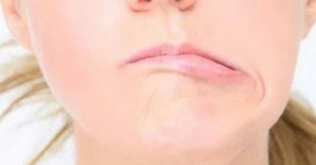 Méo miệng, lệch mặt giữa mùa hè: Nguyên nhân ít ai ngờ tới