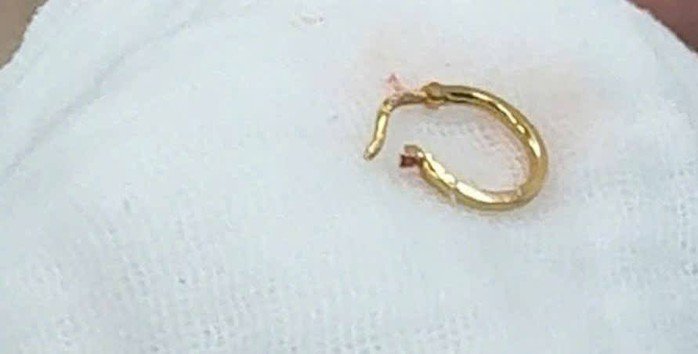 Chiếc bông tai được lấy ra khỏi thực quản của bé gái 8 tháng tuổi