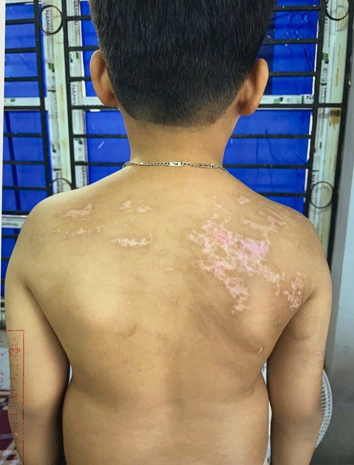 Cháu T. bị tổn thương khắp cơ thể. Ảnh: CACC