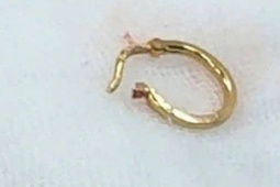 Bé gái nhập viện vì chiếc bông tai trong thực quản