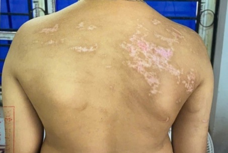 Bé trai 7 tuổi có 21 vết sẹo trên cơ thể do bị cha đẻ bạo hành