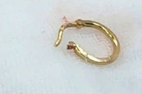 Bé gái nhập viện vì chiếc bông tai trong thực quản