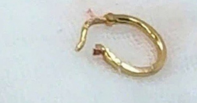 Bé gái nhập viện vì chiếc bông tai trong thực quản