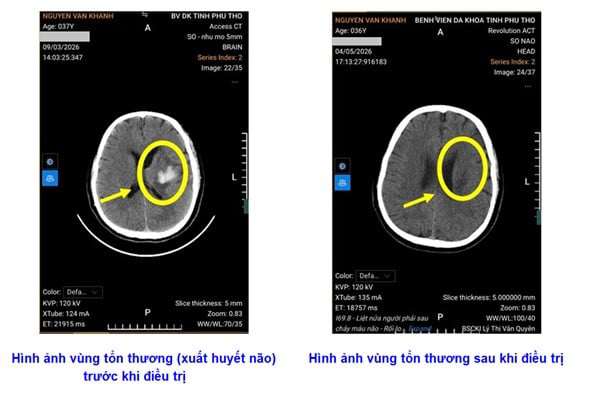 Hình ảnh xuát huyết não trước và sau điều trị. Ảnh BVCC