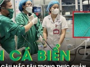 Hiếm gặp: Ăn cá biển, người đàn ông bị lưỡi câu mắc sâu trong thực quản