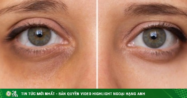 Vì sao chỉ bôi kem dưỡng mắt là chưa đủ để xóa quầng thâm và bọng mắt?