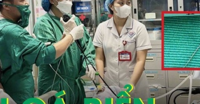 Hiếm gặp: Ăn cá biển, người đàn ông bị lưỡi câu mắc sâu trong thực quản