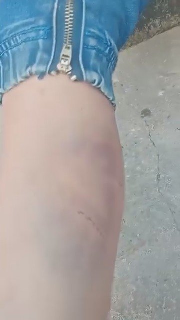 Trên cơ thể cháu xuất hiện nhiều vết bầm tím ở tay, chân và vùng mắt.