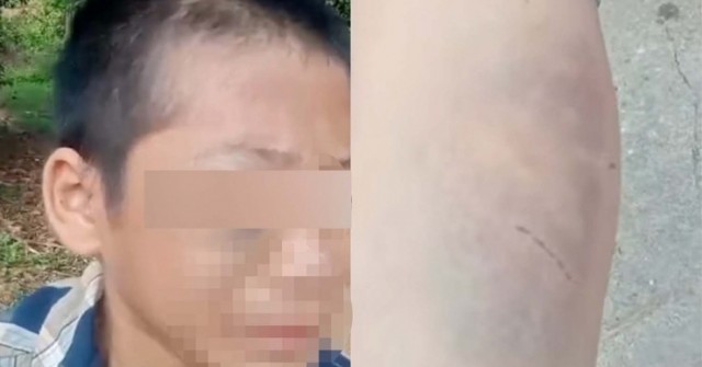 Cháu bé bầm tím khắp người ở Nghệ An: Công an vào cuộc xác minh